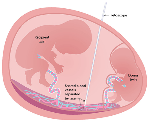 Feto Fetal Transfusion Syndrome Twin-Twin Transfusion Syndrome | OHSU